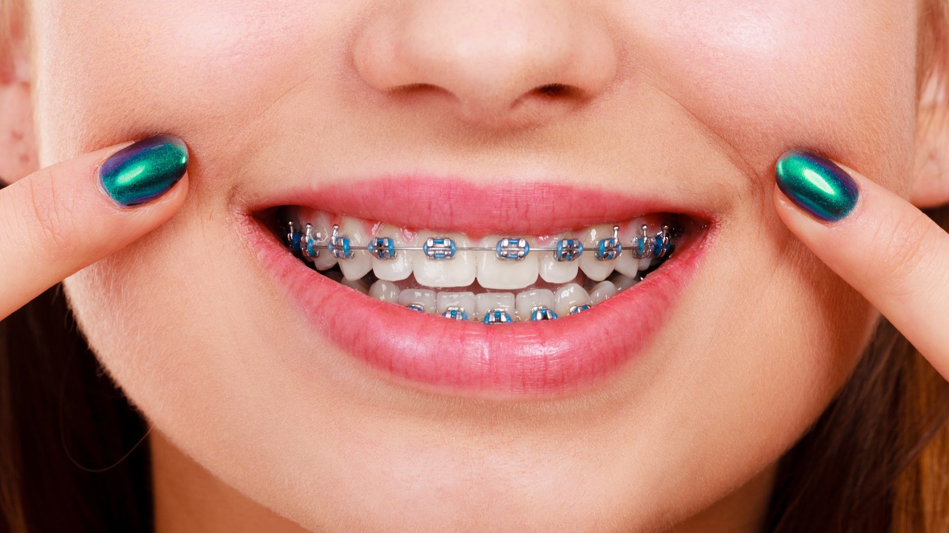 ¿Qué tipos de ortodoncia es mejor?