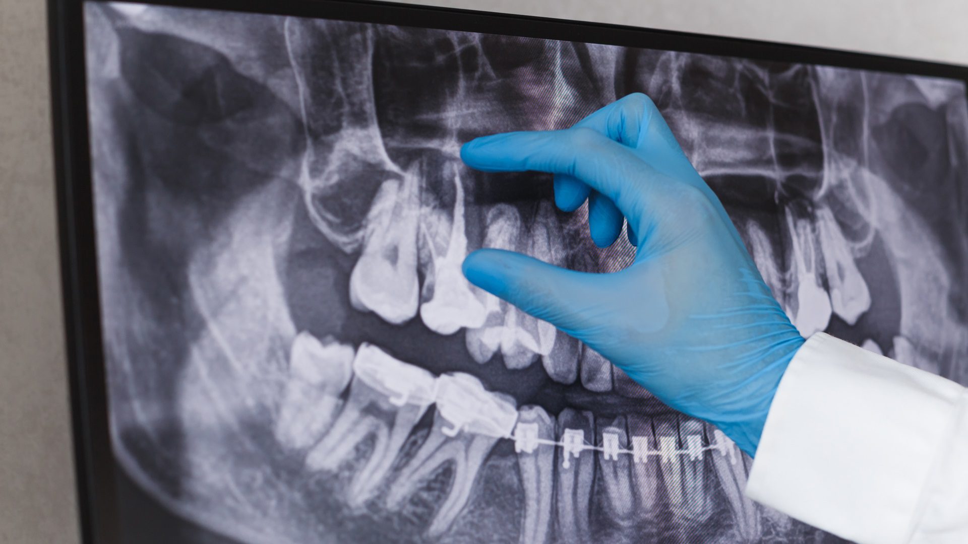 Cuidados de implantes dentales para un éxito duradero