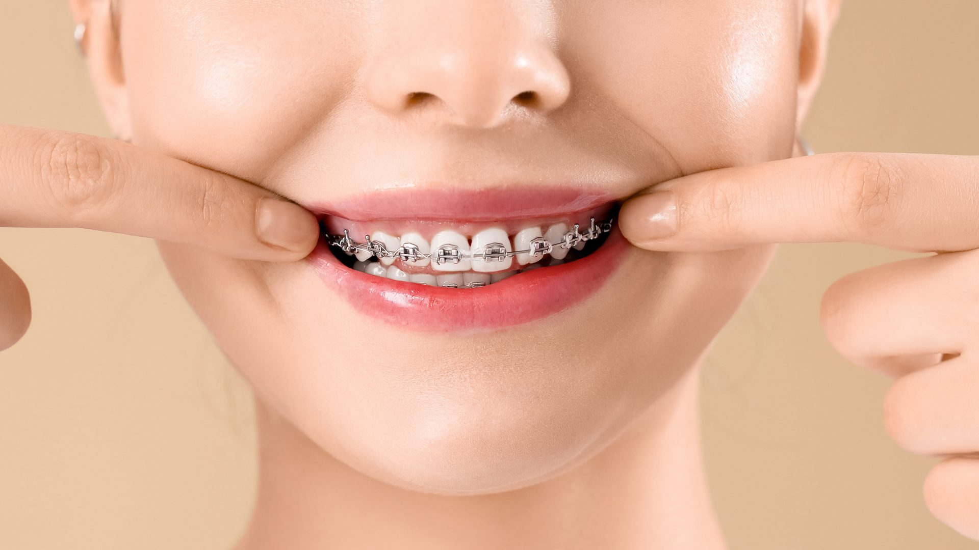 Los 10 consejos sobre la ortodoncia en adultos