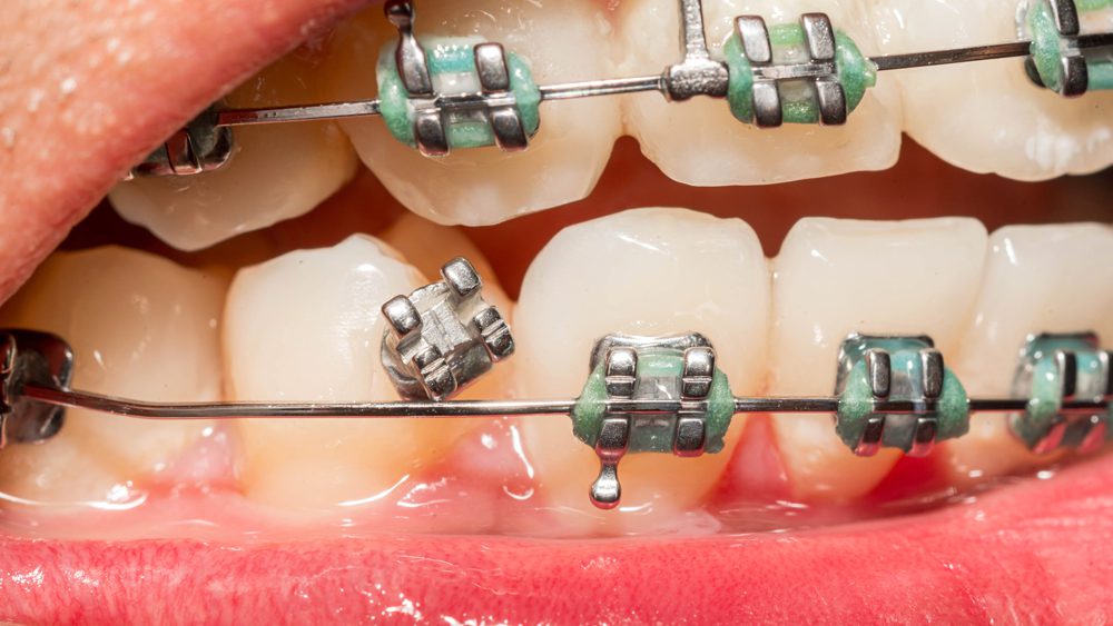 Brackets rotos por comer alimentos prohibidos