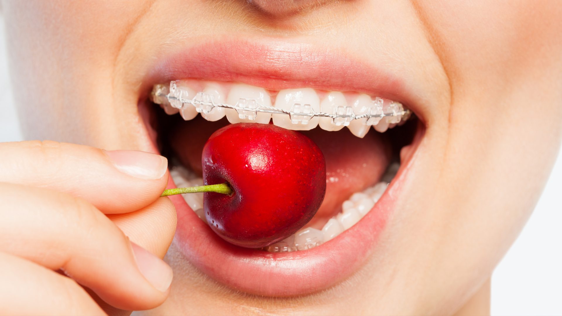 Comer con brackets: Alimentos prohibidos y permitidos