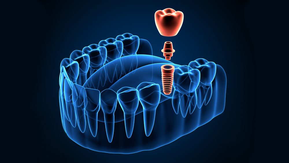 Paso a paso del tratamiento con implantes dentales