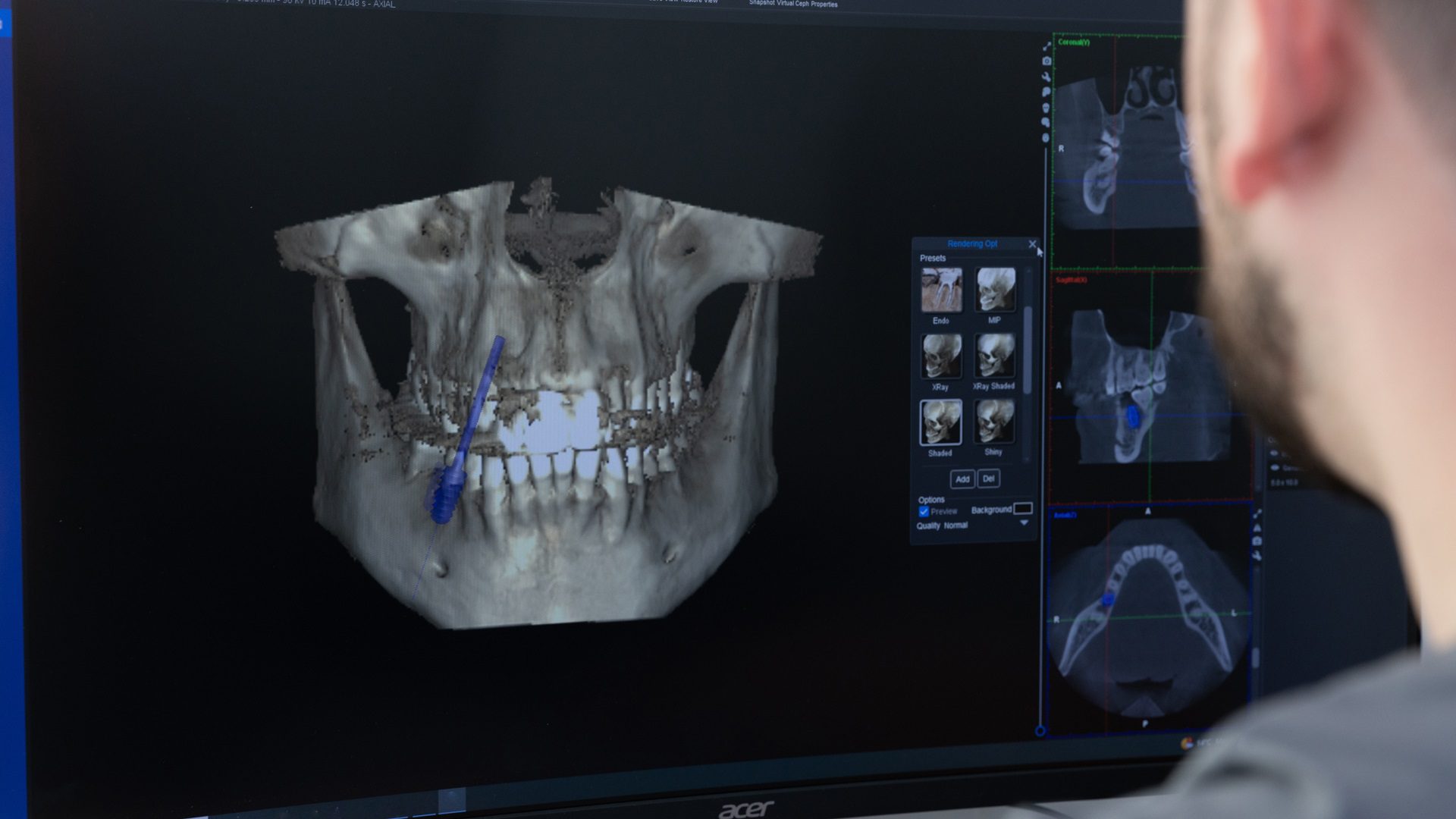 ¿Cuál es la diferencia de precios en los implantes dentales en Mallorca?